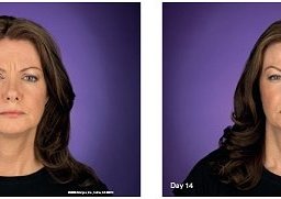 botox treatment4
