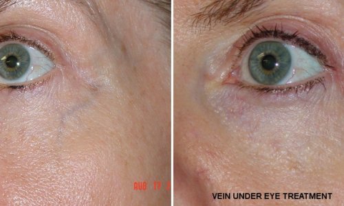 vein under eye treatment1