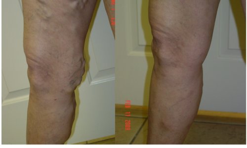 vein legs sclerotherapy