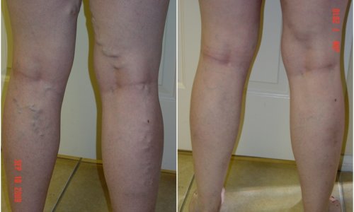vein legs treatment