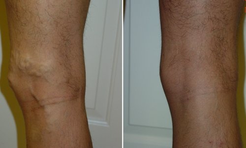 vein legs treatment